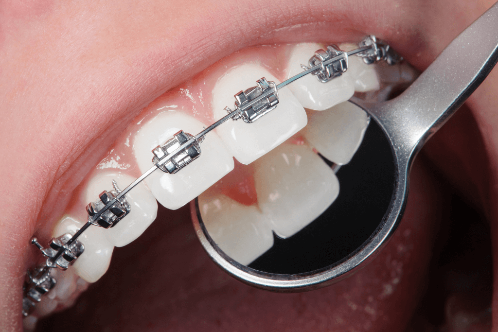 metal braces work