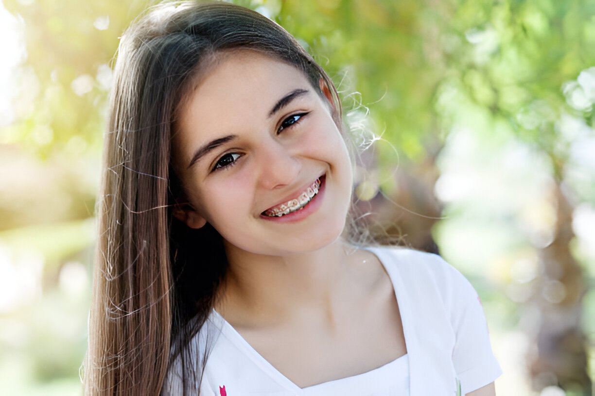 How Long Do I Have to Wear Braces?