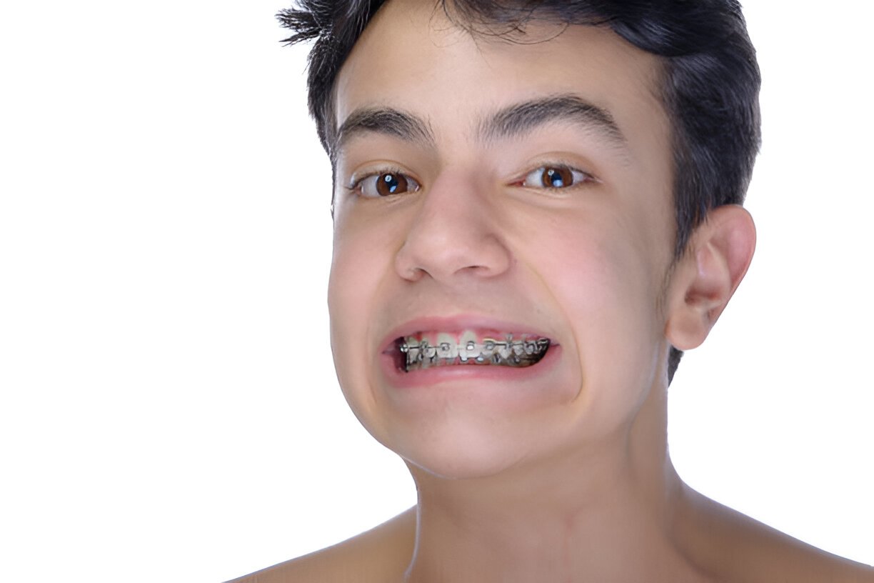 Do Braces Weaken Teeth?