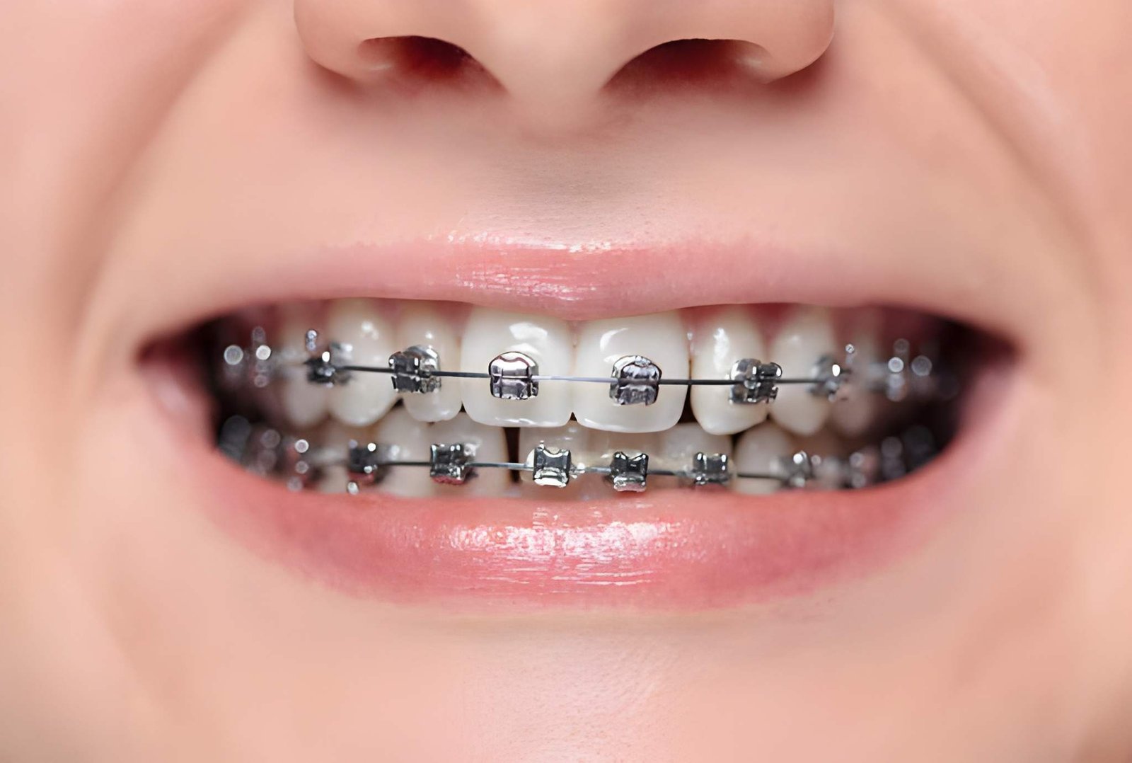 Braces Treatment in Aberdeen